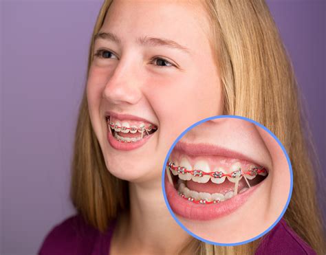 What Do Triangle Rubber Bands Do for Braces? And Why Do They Make Orthodontists Smile Like They Just Won the Lottery?